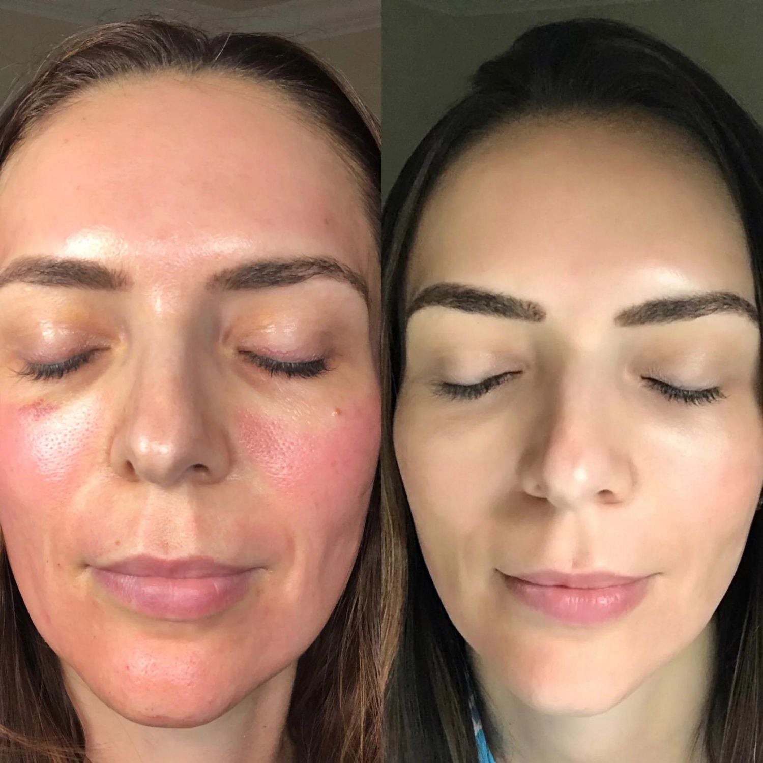 CO2 Lift Pro Carboxy treatment before and after results 1