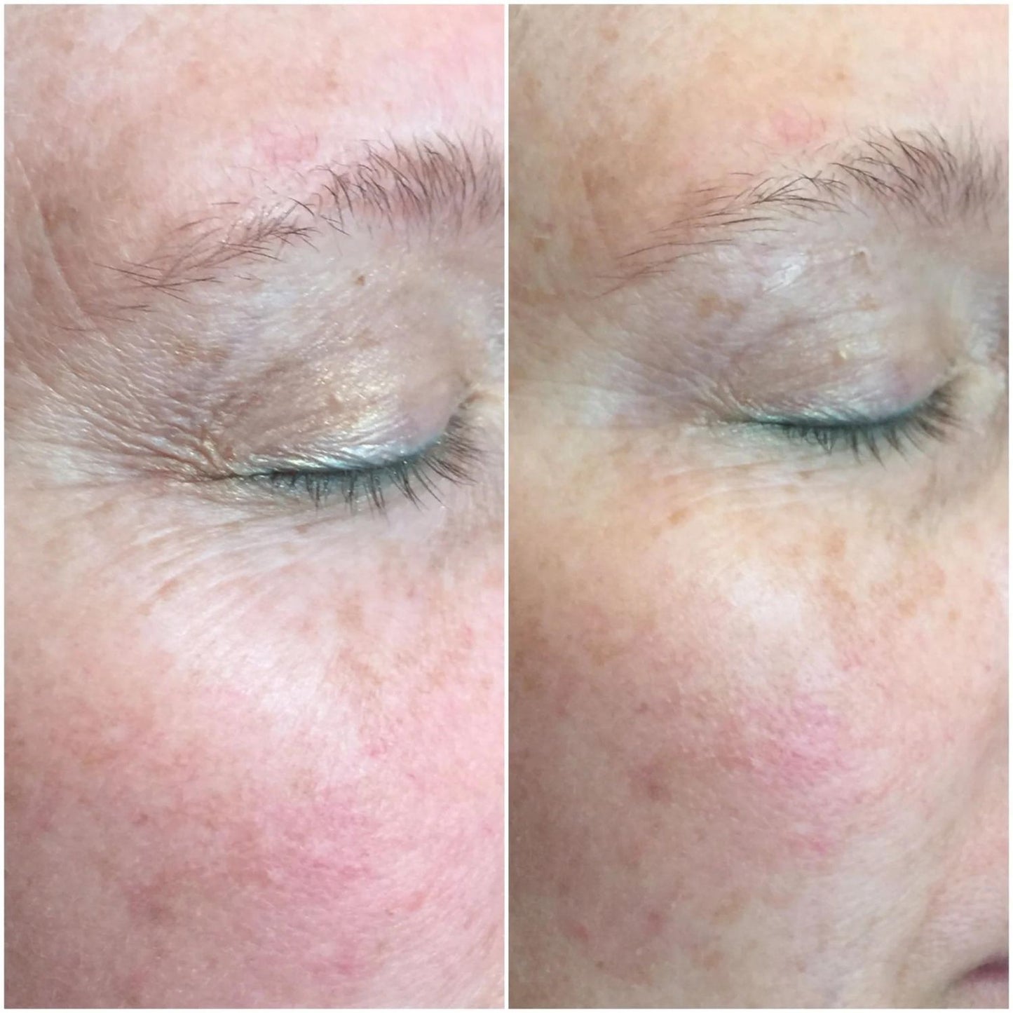 CO2 Lift Pro Carboxy treatment before and after results 2