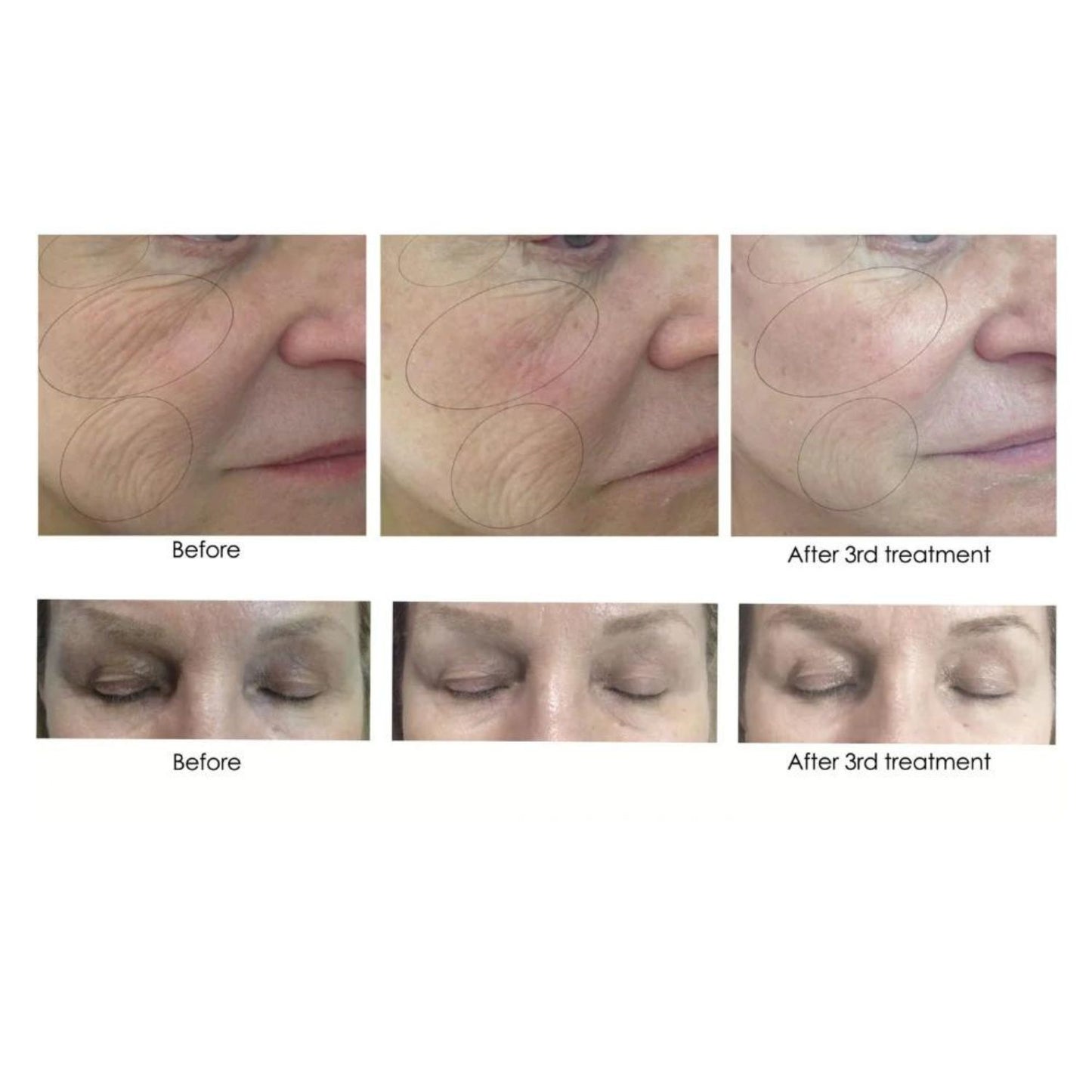 CO2 Lift Pro Carboxy treatment before and after results 3