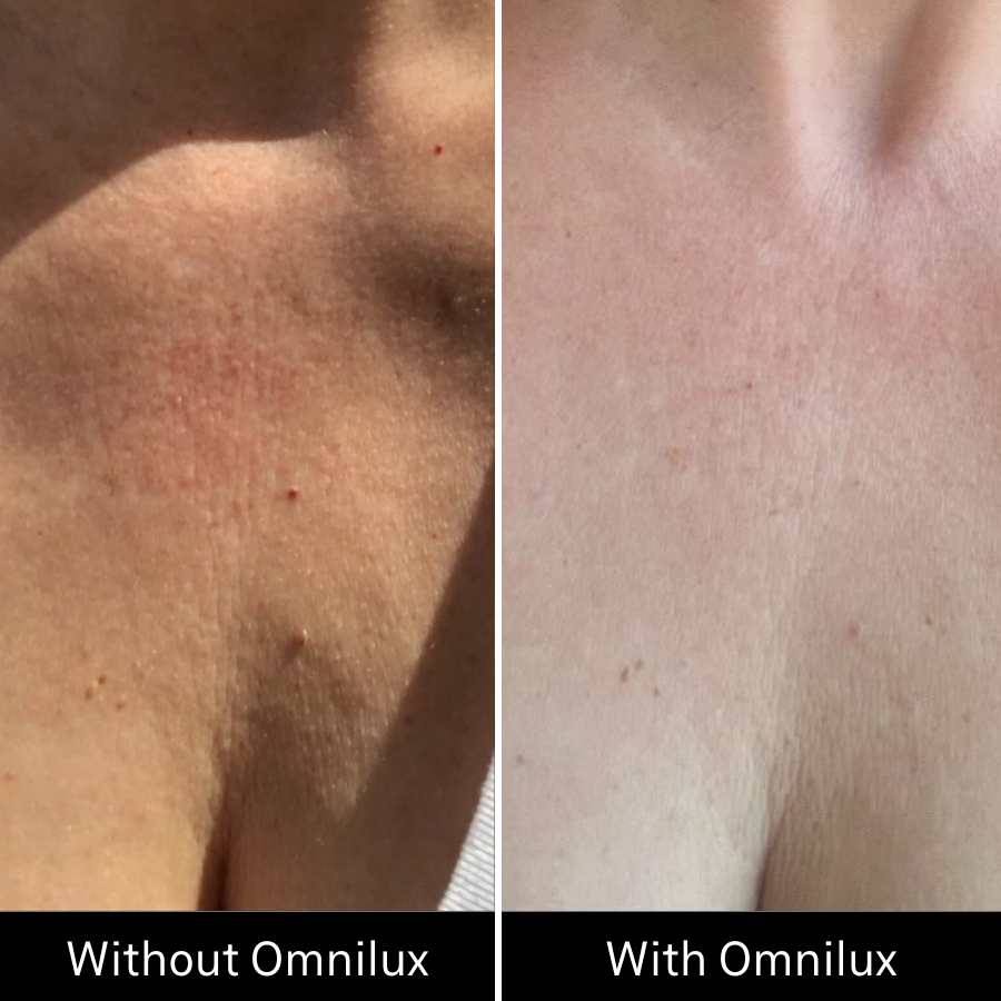 Before and after images of womans decolletage after using omnilux light therapy