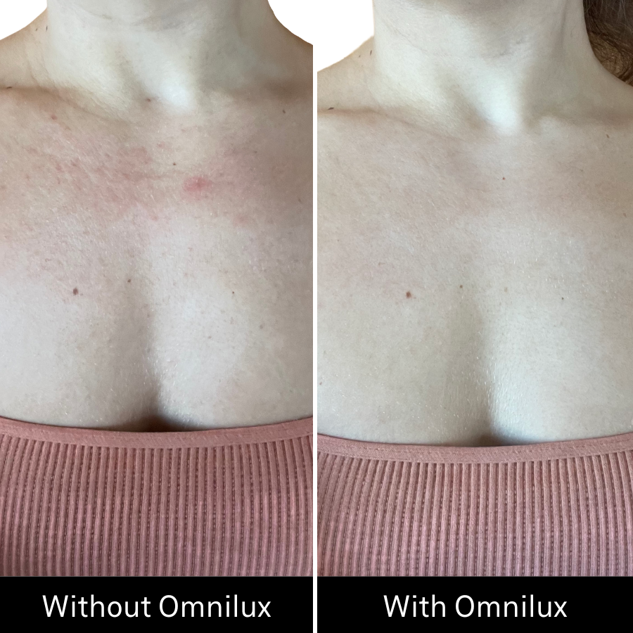 Before and after image of clearer skin pigmentation on woman's decolletage after using omnilux contour