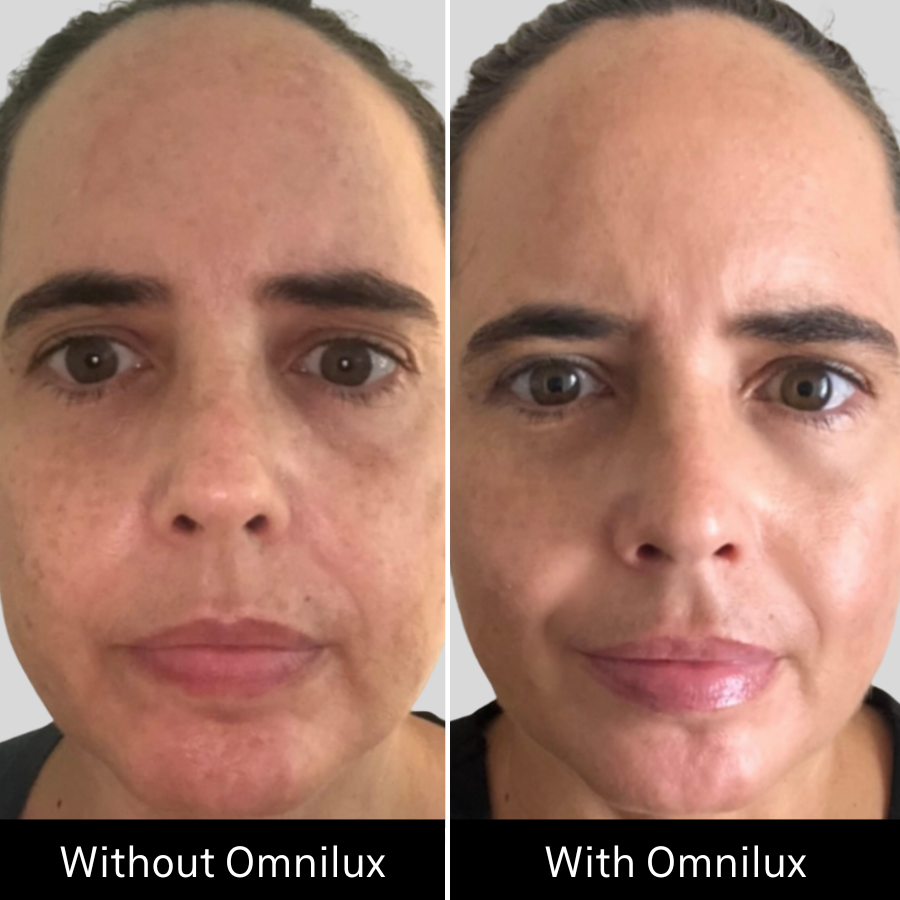 Before and after of womans skin complexion with and without omnilux