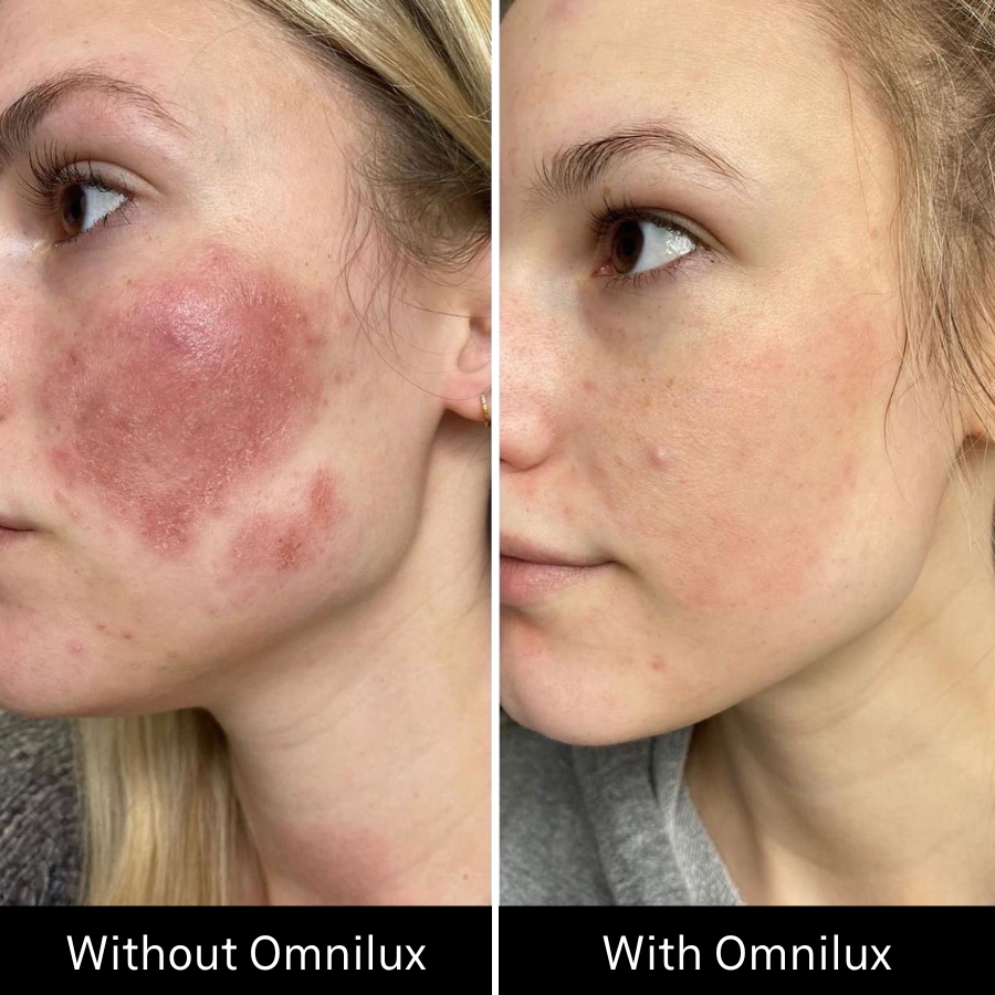 Before and after of womans skin complexion with and without omnilux