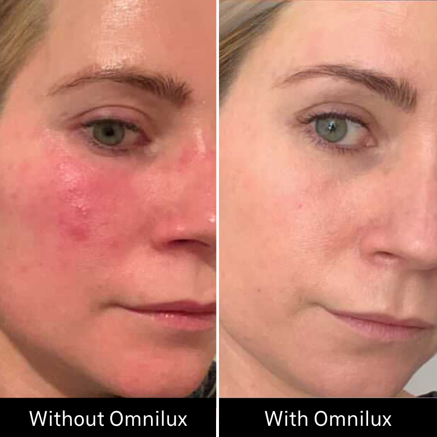 Before and after of womans skin complexion with and without omnilux