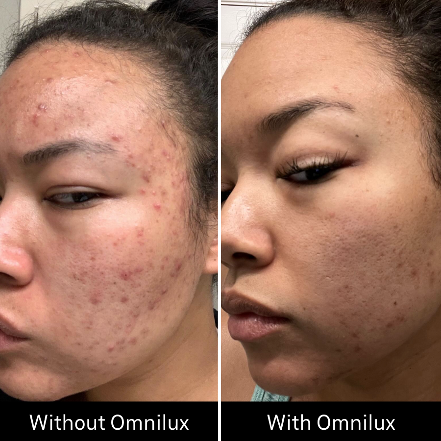 Before and after image of acne on girls face