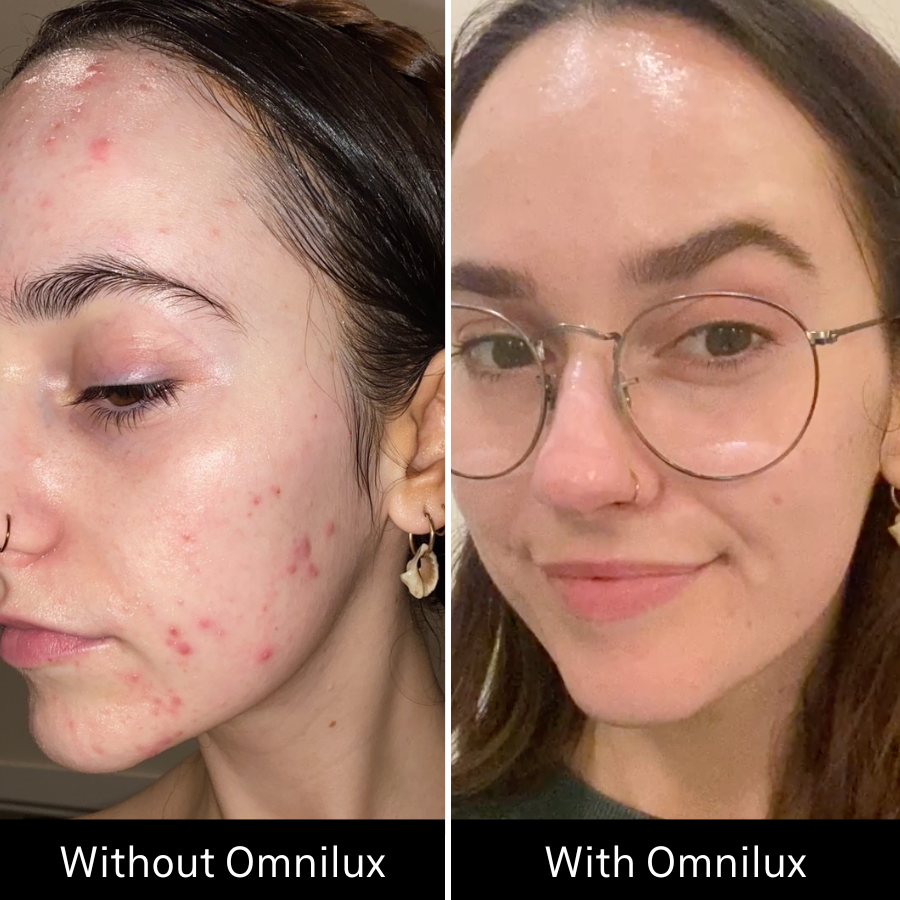 Before and after image of acne on girls face