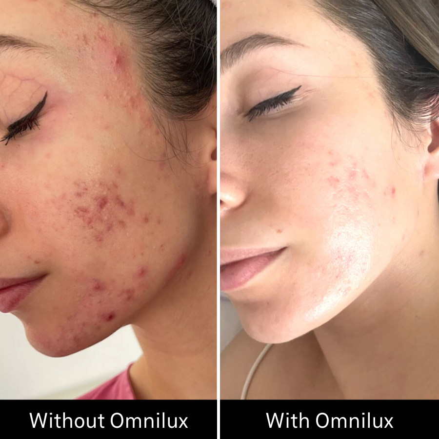 Before and after image of acne on girls face